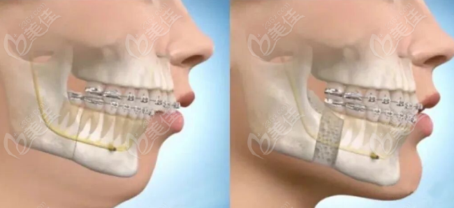 肖林正頜手術(shù)凸嘴成功實(shí)例分享 肖林正頜手術(shù)凸嘴成功實(shí)例分享