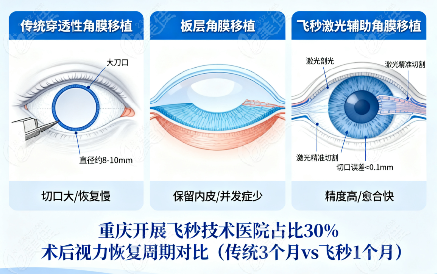 重慶眼角膜移植手術(shù)