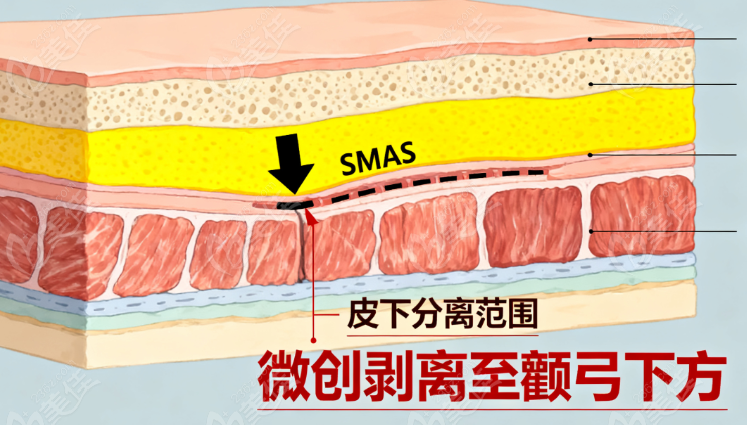 广州陈兵医生拉皮手术是正规的吗