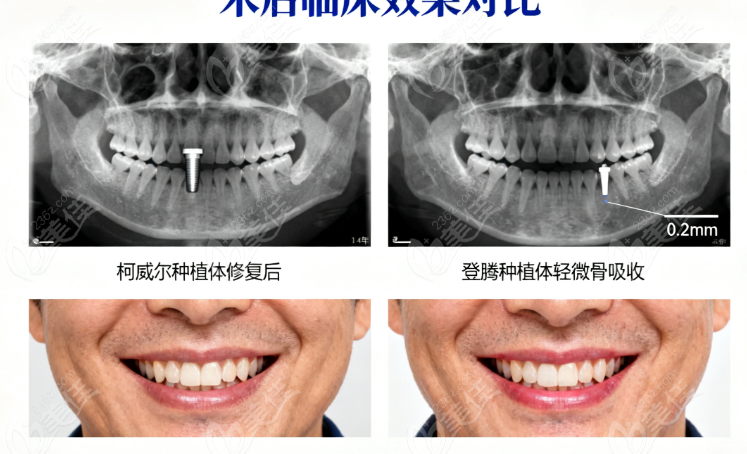 柯威尔种植体与登腾如何抉择