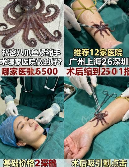 私密八爪鱼紧缩手术哪家医院做的好