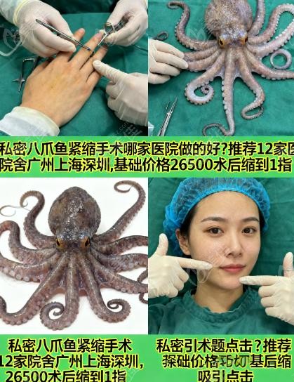 私密八爪鱼紧缩手术成效如何