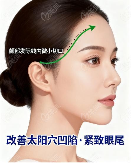 八大处颞部提升多少钱受哪些因素影响