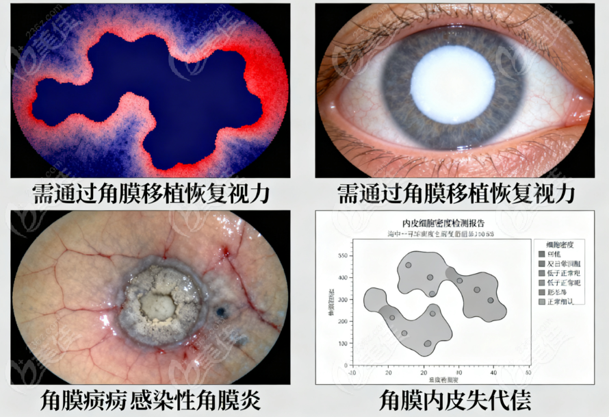 重慶普瑞眼科醫(yī)院換眼角膜