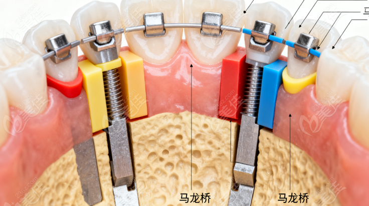 马龙桥架