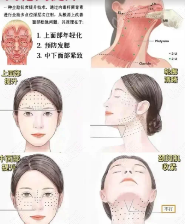 英伦大提升示意图