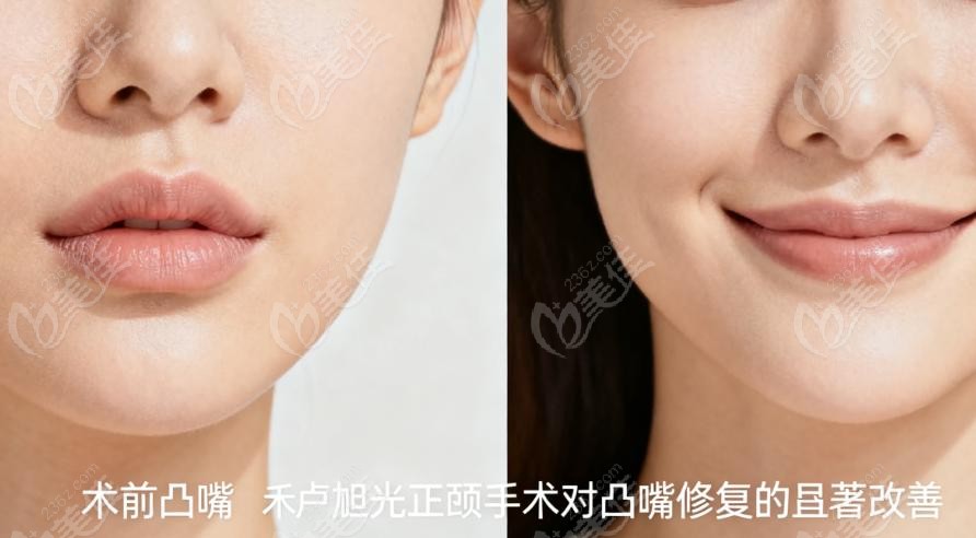 北京嘉禾口腔卢旭光做正颌真的香