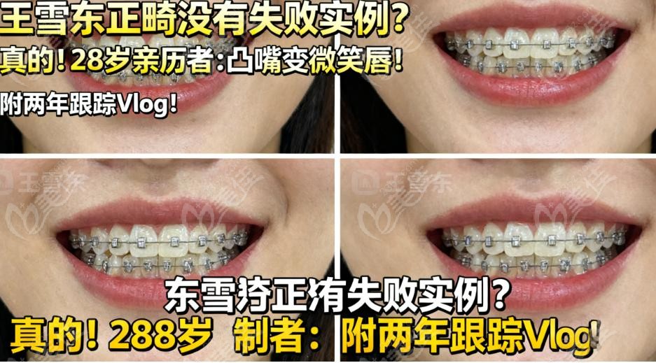 王雪东正畸亲自动手吗？28 岁亲历者：从方案到调整全是他