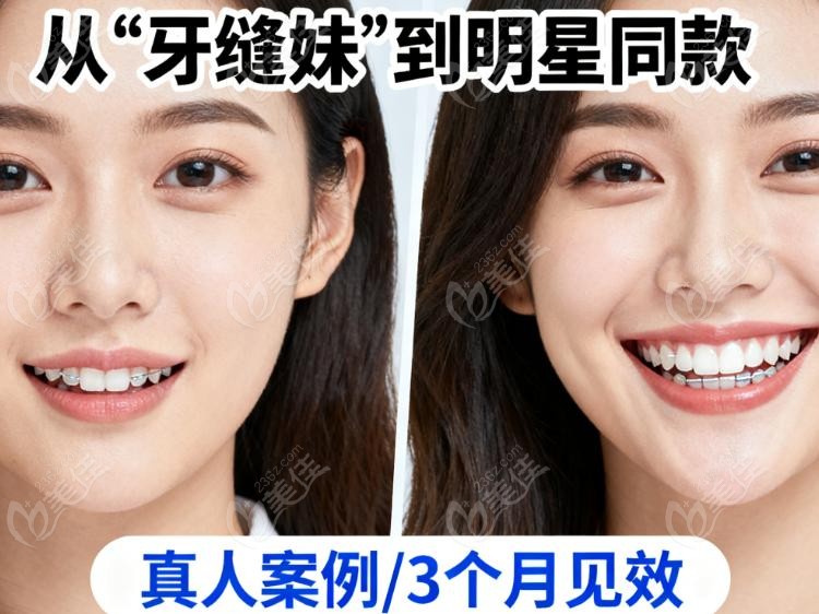 笑研所隐形矫正怎么样？3 大核心优势，比传统矫正省心 10 倍