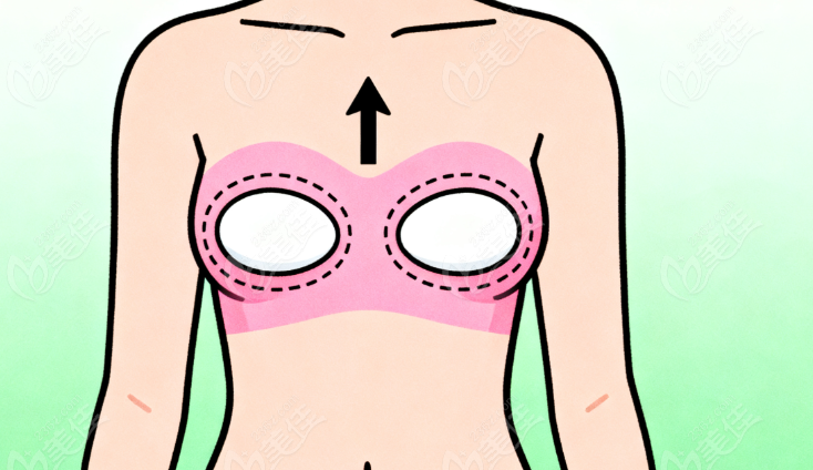 上海李海濤醫(yī)生隆胸手術(shù) 上海李海濤醫(yī)生隆胸手術(shù)