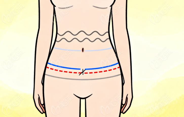 上海李海濤腹壁整形手術(shù) 上海李海濤腹壁整形手術(shù)