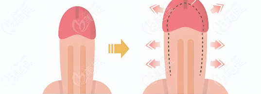 成都男性生殖器整形哪家医院好又正规