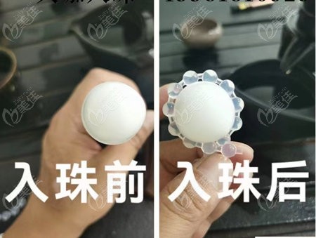 韓國入珠手術3種常見材質優缺點對比