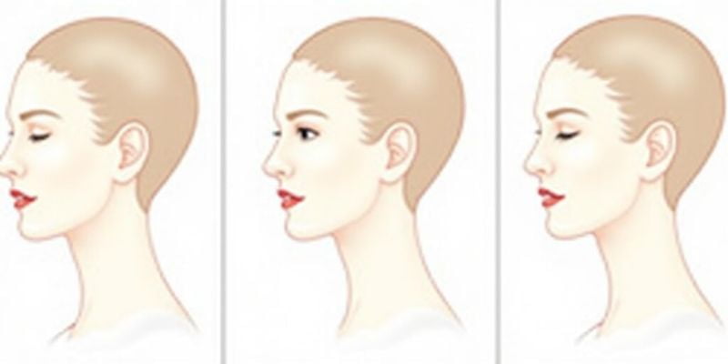 埋線提升的適用人群和療效