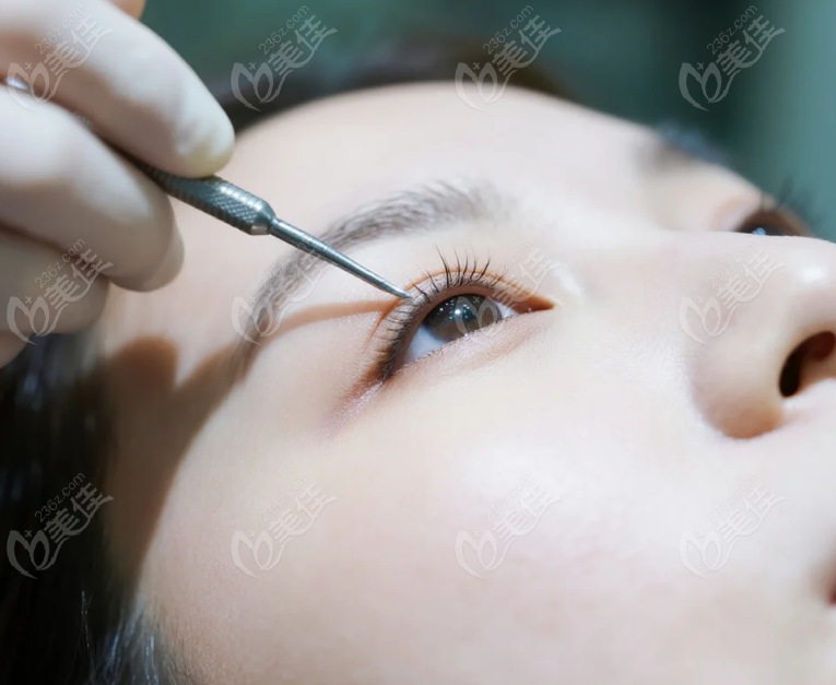 成都銅雀臺雙眼皮價格