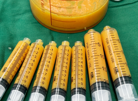 成都艾米麗脂肪填充價(jià)格