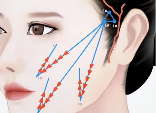 廣州筋膜提升大概多少錢