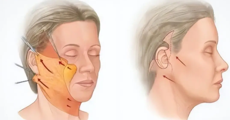 廣州筋膜提升當(dāng)下價格總表