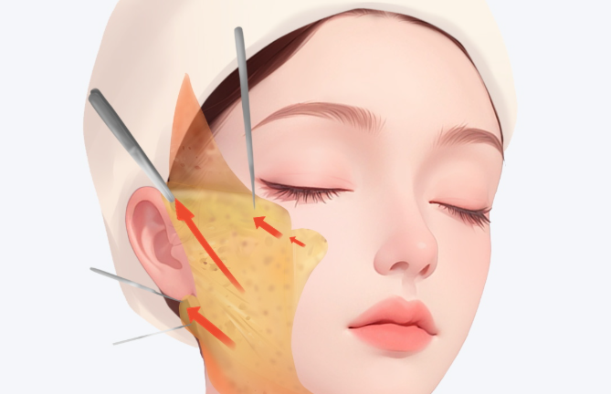 廣州筋膜提升避坑指南