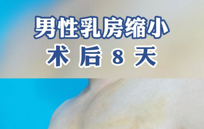 叶桐江做男生乳房缩小手术