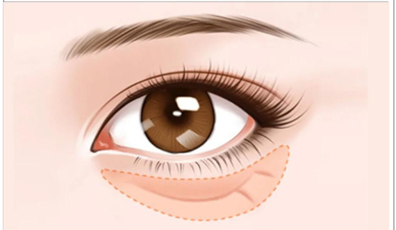 西安伊美爾去眼袋預(yù)約掛號