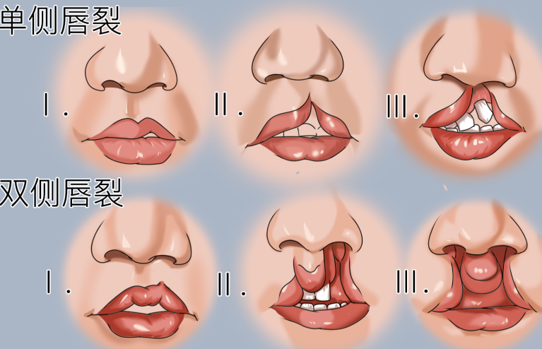 毛喆醫(yī)生唇裂技術(shù)怎么樣