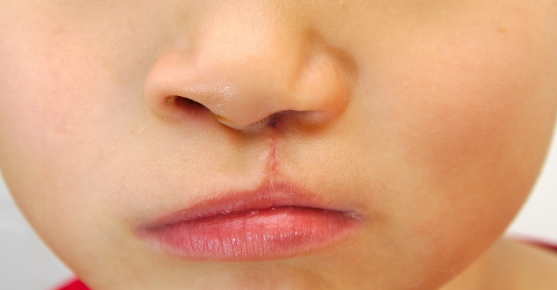 唇裂技術(shù)治療療效與患者評價