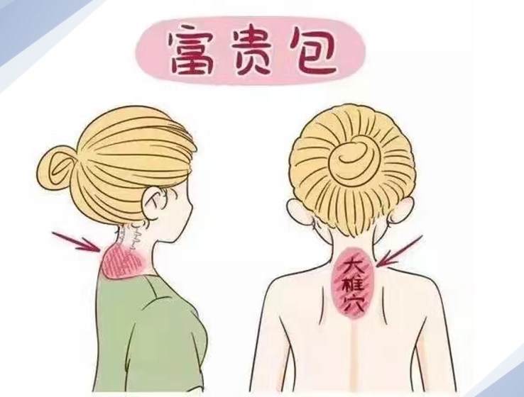 李方偉富貴包微創(chuàng)術(shù)詳情