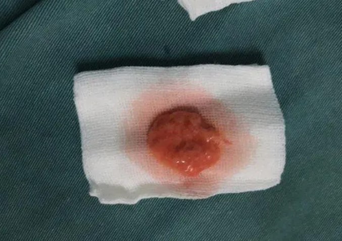 方閏醫(yī)生生長(zhǎng)因子取出圖片