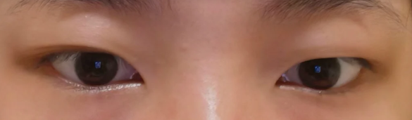 樓善葉雙眼皮修復(fù)價格