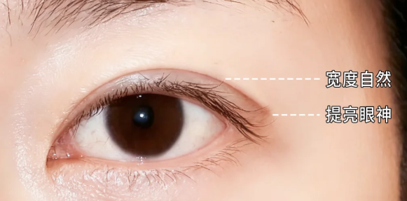 楼善叶双眼皮修复技术的“稳”,藏在细节里
