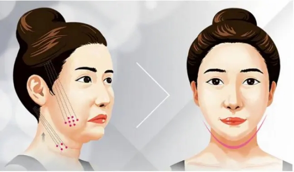 上海中下臉拉提價(jià)格