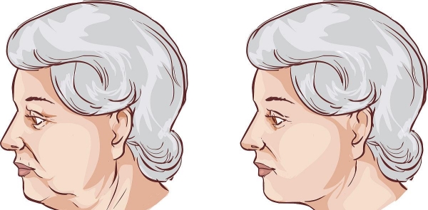 上海中下臉拉提