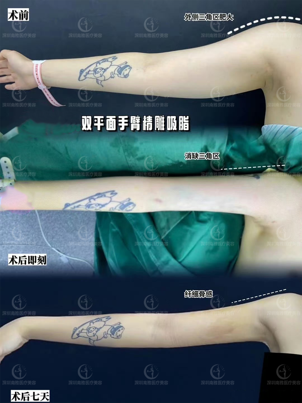 一、維密吸脂和水動力吸脂的核心區(qū)別：從原理到療效全解析