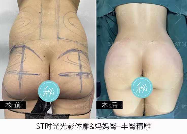 三、想做吸脂選哪家？以成都萊瑞拉為例看正規(guī)醫(yī)院的選擇要點