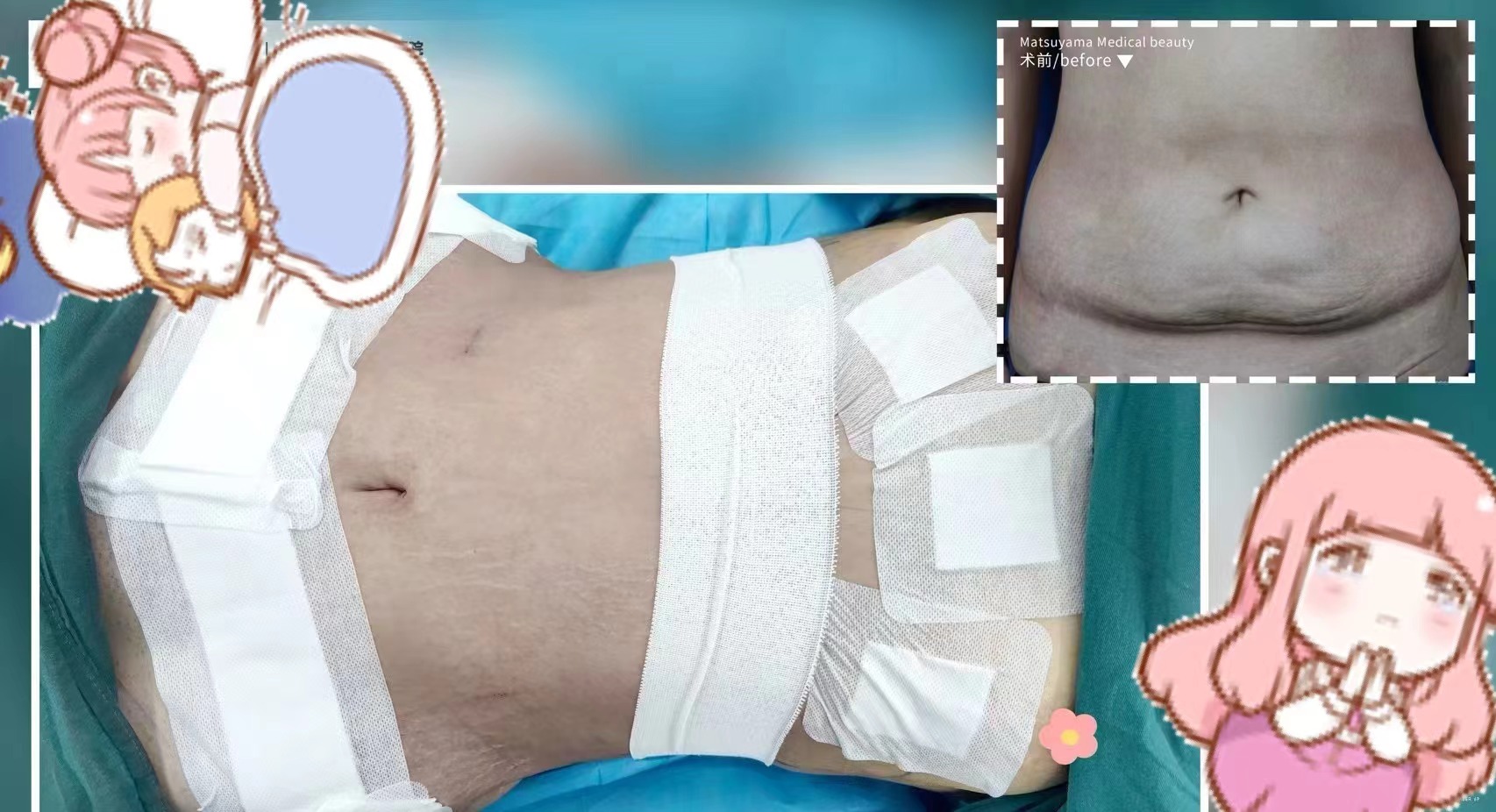 四、成都萊瑞拉吸脂怎么預(yù)約？附到院交通指南