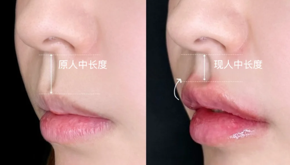 王皓民人中修復(fù)實(shí)例