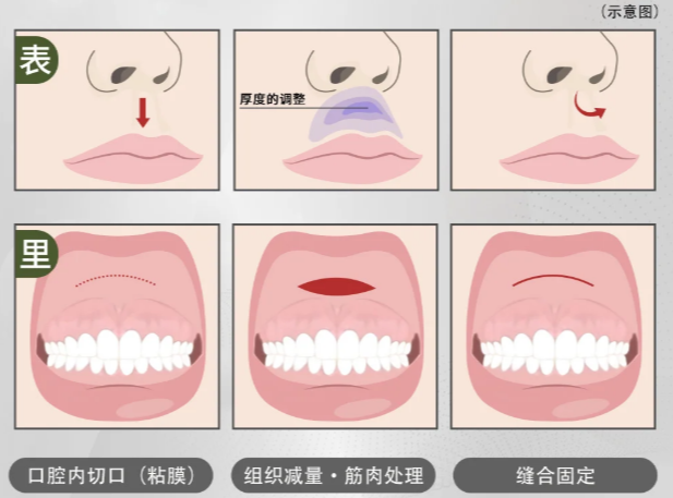 傳統(tǒng)術(shù)式VS王皓民人中修復(fù)：3組對(duì)比圖里的核心差異
