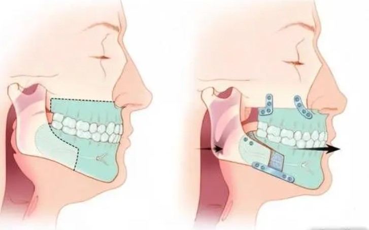 李繼華和羅恩哪個(gè)技術(shù)好