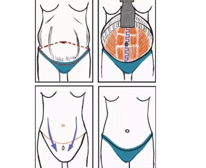 四川現(xiàn)代醫(yī)院李獻(xiàn)和腹壁整形封神