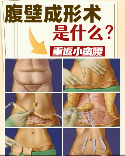 李獻(xiàn)和腹壁整形的神成療效