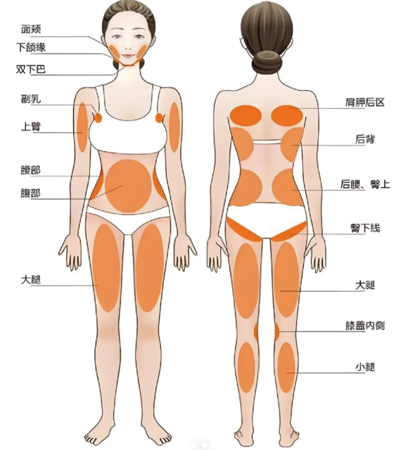 局部抽脂手術示意圖