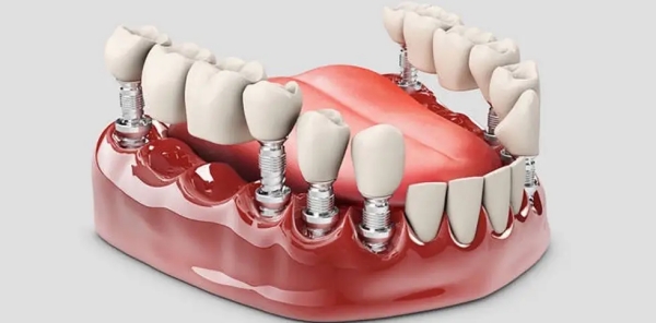 防城港好百年口腔種植牙