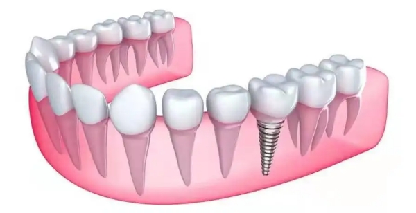 重慶種博士口腔種植牙