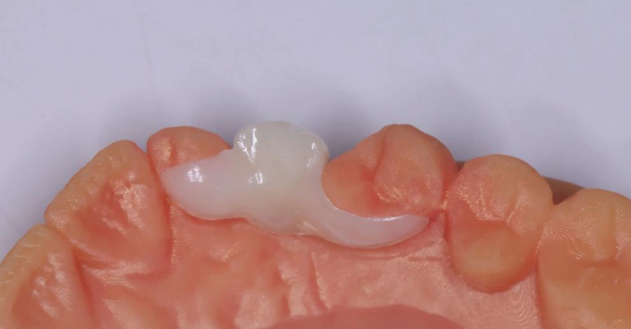 連橋與不連橋種植牙