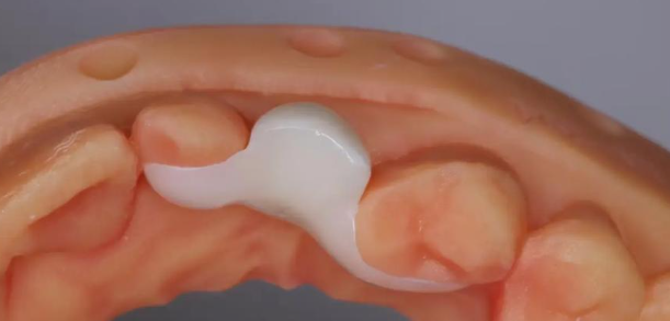 連橋與不連橋種植牙誤區(qū)