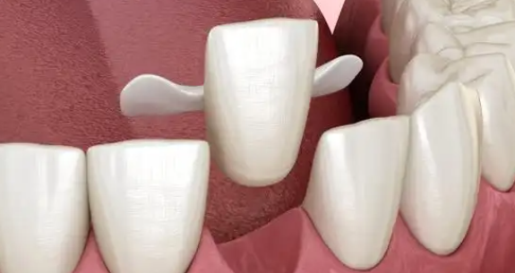 馬龍橋架與普通連橋種植牙