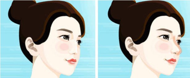 房志強(qiáng)和馮雁平隆鼻真實(shí)評(píng)價(jià)