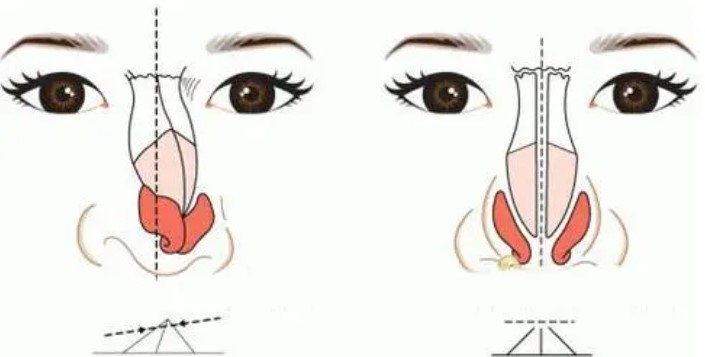 房志強(qiáng)和馮雁平隆鼻技術(shù)哪個(gè)好