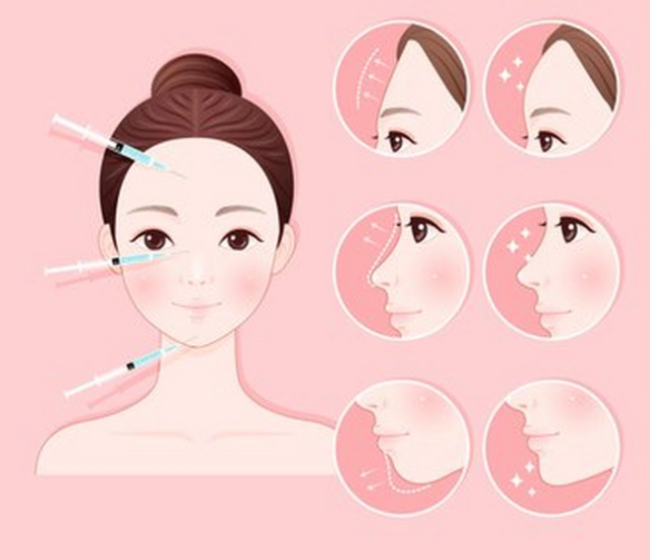 膠原灌注提升技術(shù)